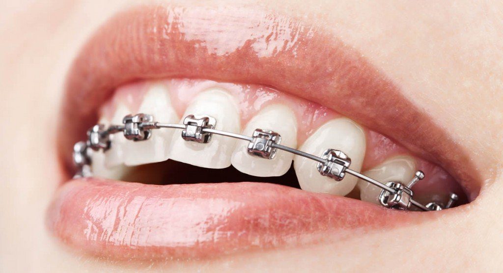 understanding metal braces